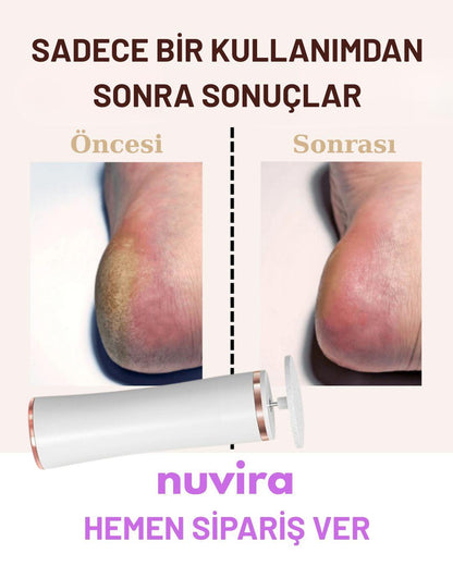 Nuvira - Ayak Törpü Cihazı